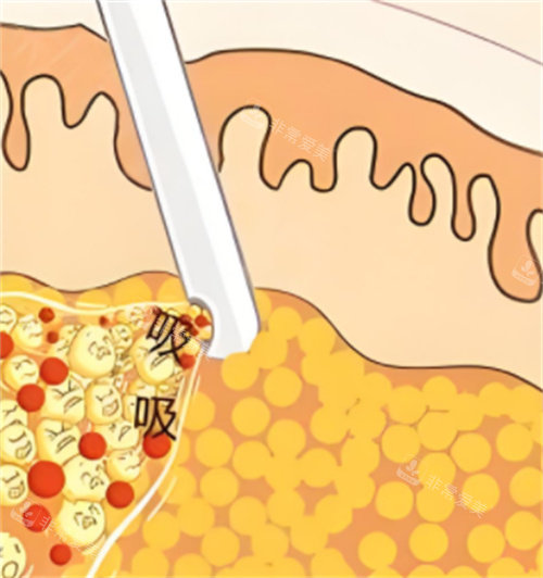 花20万找冯斌吸脂的真实体验：高清晰逐层扫描技术如何重塑我的身材？