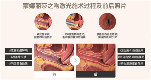 韩国信所爱女性医院蒙娜丽莎之吻激光
