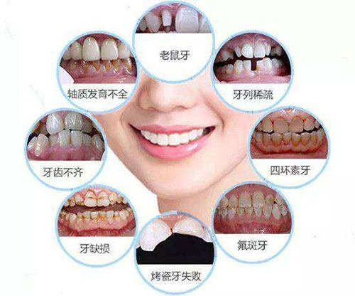 牙齿贴面情况示意图