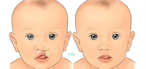 单侧鼻畸形兔唇儿术后对比