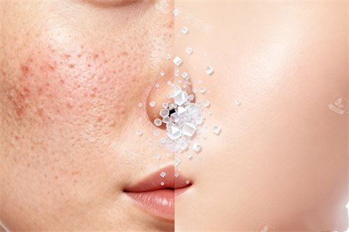 脸部祛痘卡通图 脸部祛痘卡通图