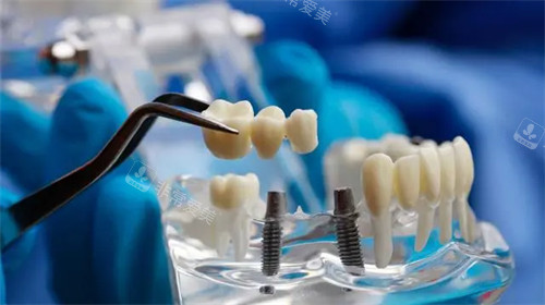 种植牙植体和牙冠安装模型示意图