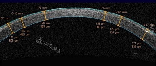 飞秒激光角膜瓣厚度