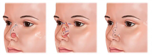 鼻缺失修复一览