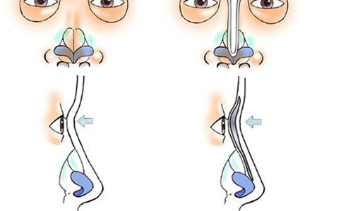 鼻小柱延长的手术流程图