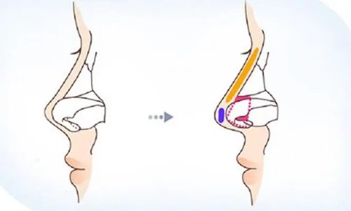 在韩国注射隆鼻怎么样？我的体验是：鼻小柱基底抬高后鼻子立刻立体，嘴凸改善明显，0.3ml鼻尖延长让侧面更精致