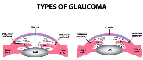 开角型和闭角型青光眼