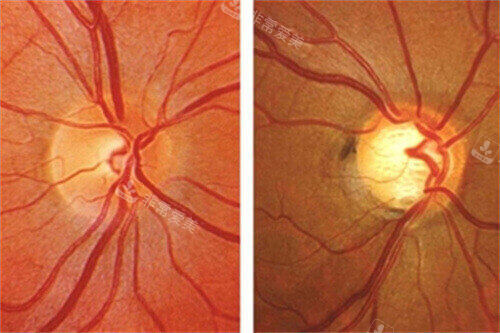 青光眼眼球示意图
