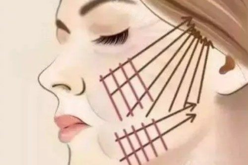 埋线提升卡通图片展示