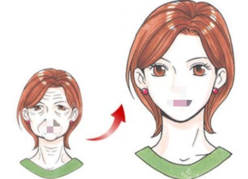 拉皮手术前后对比图