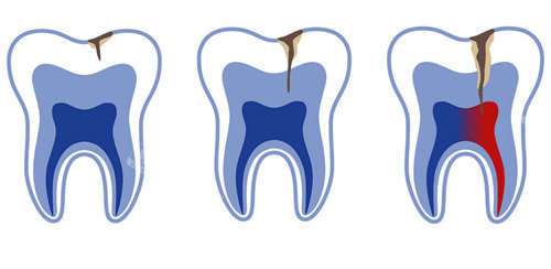牙釉质牙齿龋坏不同程度