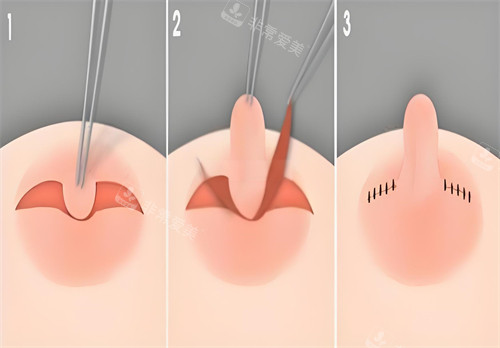 乳头内陷矫正手术图解