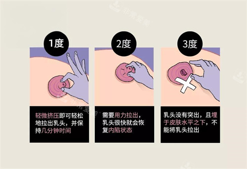 乳头内陷按摩方式图