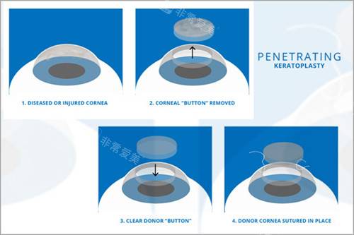 角膜移植过程图示