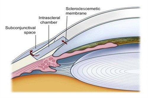 滤过行手术青光眼