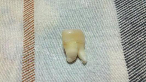 智齿实物展示图