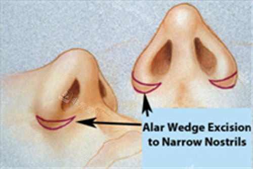 鼻翼缩小对比图