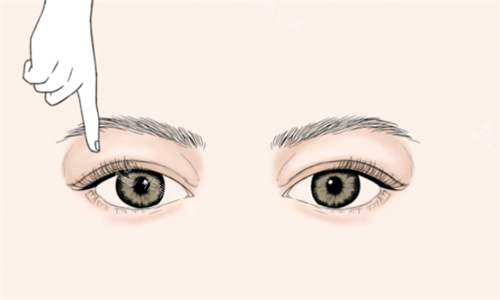 双眼皮手术设计 双眼皮手术设计