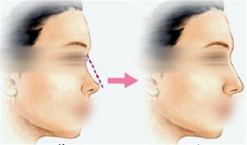 鼻背隆鼻填充前后对比图