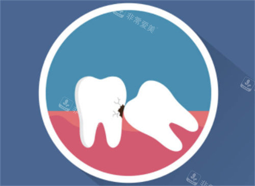 牙齿拥挤示意图