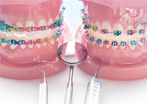 牙齿矫正模型图片