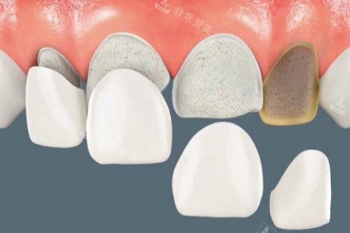 牙贴面卡通图片展示