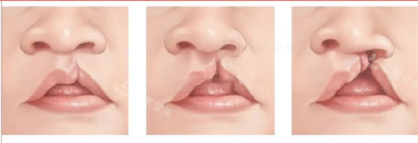 单侧唇裂 单侧唇裂