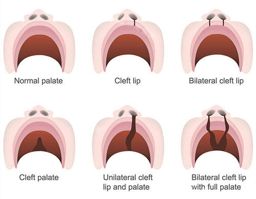唇裂修复类型 唇裂修复类型