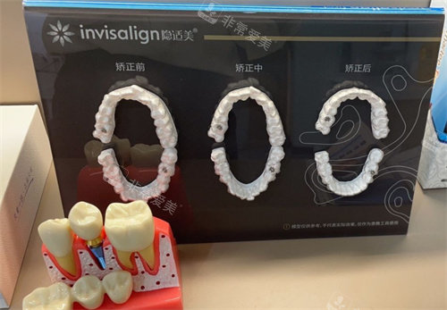天津伊诚口腔牙模展示