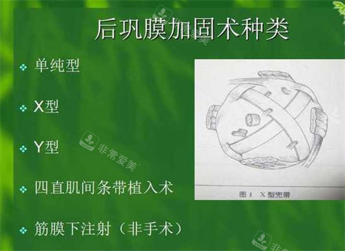 后巩膜加固术种类