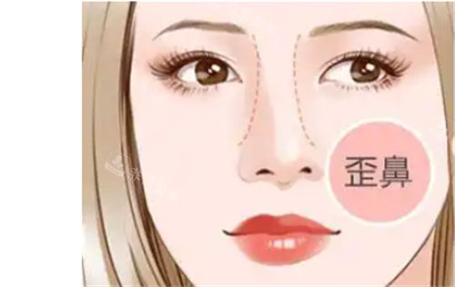 歪鼻修复