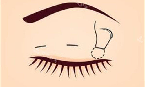 广州双眼皮医生排名前...