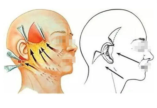 拉皮手术前后提拉对比图