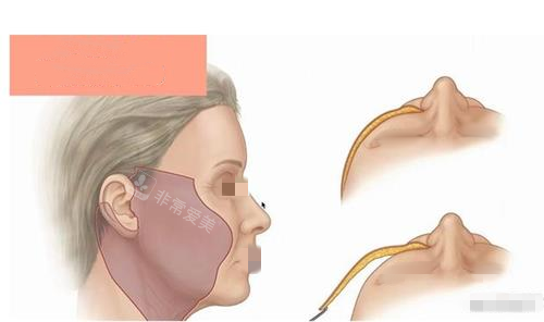 2026拉皮手术医生排名...