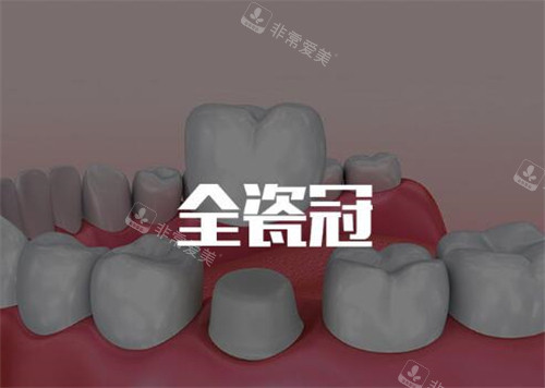 全瓷牙冠修复改善