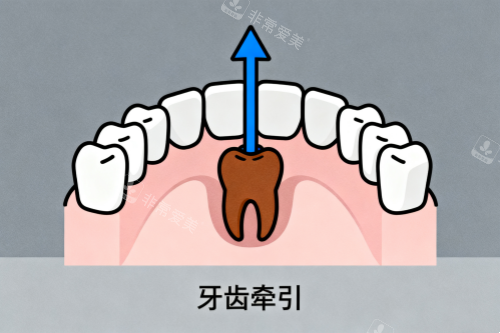 牙齿牵引卡通图