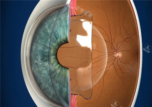 晶体植入近视手术模拟图