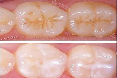 牙齿窝沟封闭对比示意图