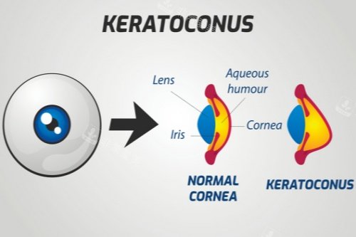 圆锥角膜结构示意