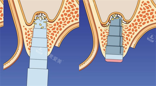 上颌窦提升示意图