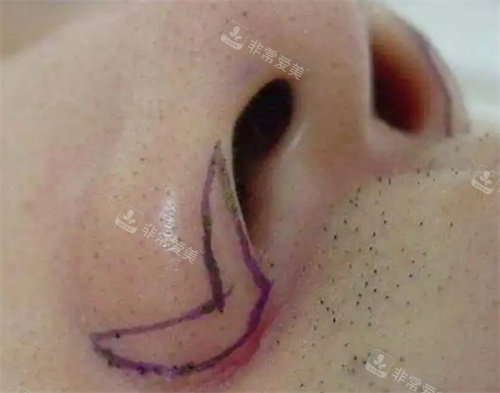 鼻翼切口设计位置图