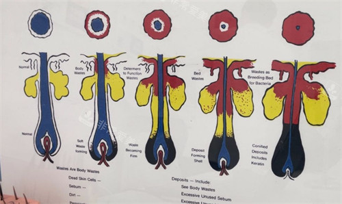 成都雍禾植发毛囊生长过程展示