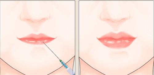 注射丰唇手术