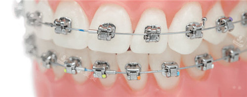 自锁托槽矫正器模型