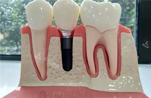 种植牙假牙模具图片 