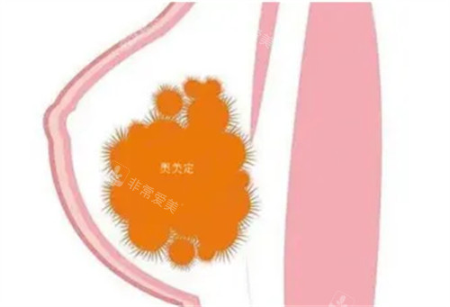 韩国异物填充修复有哪...