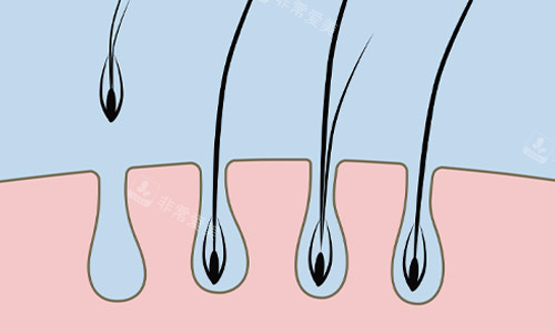 韩国做发际线种植好的...