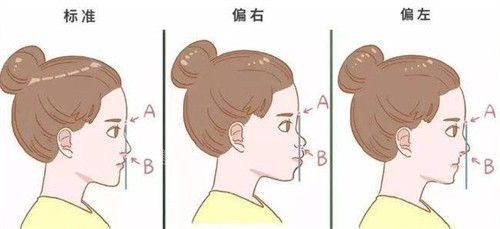 鼻基底凹陷的不同程度