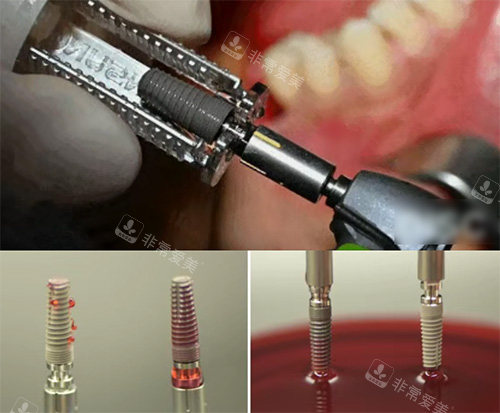 康盛种植牙照片