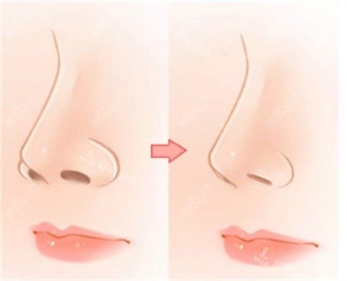 鼻翼缩小整形手术